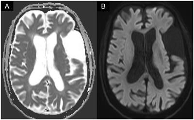 Case report: Dysphagia after COVID-19 infection in a stroke patient—Is neurostimulation a potential management?